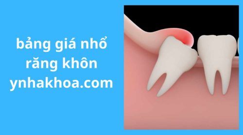bảng giá nhổ răng khôn