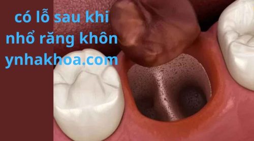 Lỗ Sau Khi Nhổ Răng Khôn