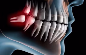 Giá Dịch Vụ Nhổ Răng Khôn Tại Các Phòng Khám Nha Khoa