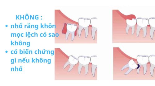 không nhổ răng khôn hàm dưới mọc lệch có sao không