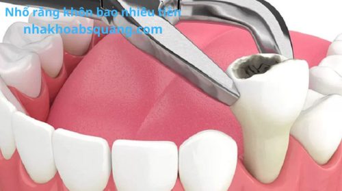 nhổ răng khôn bao nhiêu tiền