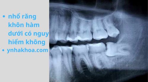 nhổ răng khôn hàm dưới có nguy hiểm không