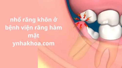 nhổ răng khôn ở bệnh viện răng hàm mặt