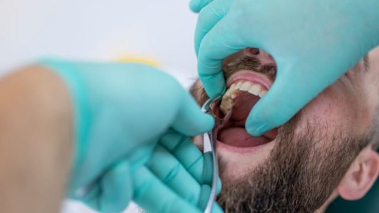 Giá Nhổ Răng Khôn Bệnh Viện Răng Hàm Mặt TPHCM: Bí Kíp Tiết Kiệm Chi Phí