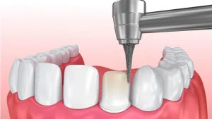 Quy trình mài răng bọc sứ: Hướng dẫn chi tiết từ A đến Z